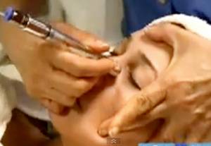 Microdermabrasion Microdermabrasion