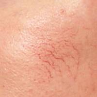 spider veins spider veins